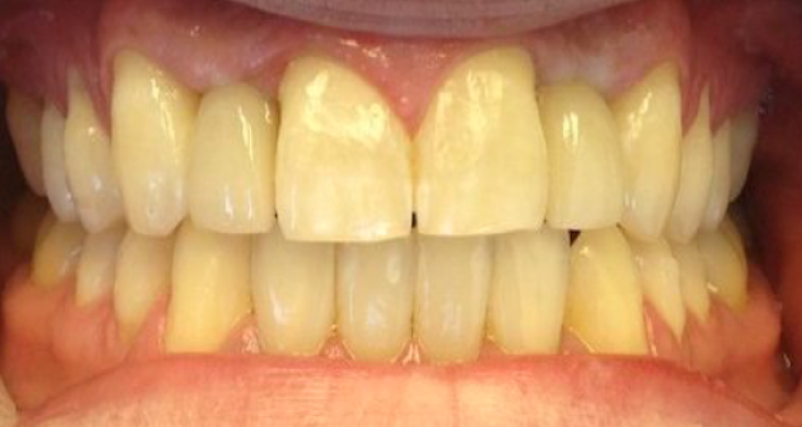 Teeth in a day after treatment